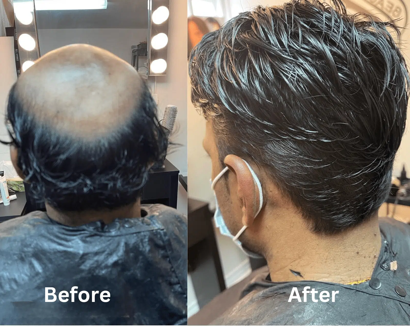 Non Surgical Hair Replacement System Service in Toronto