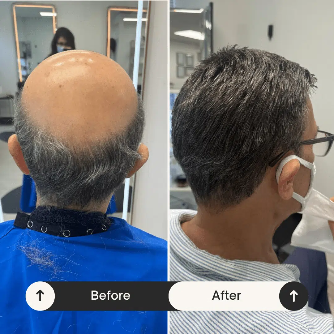 before and after hair replacement system