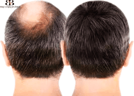 Toronto Hair System at Biro Hair Studio: A Comprehensive Guide