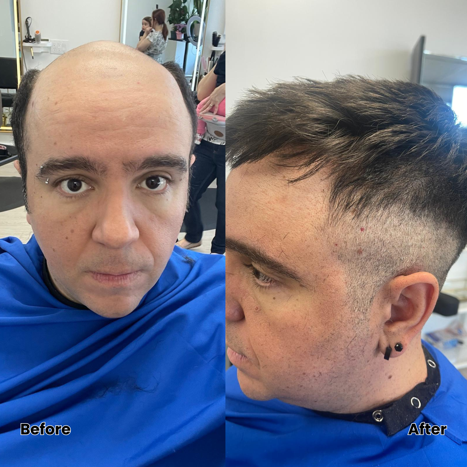 hair replacement results