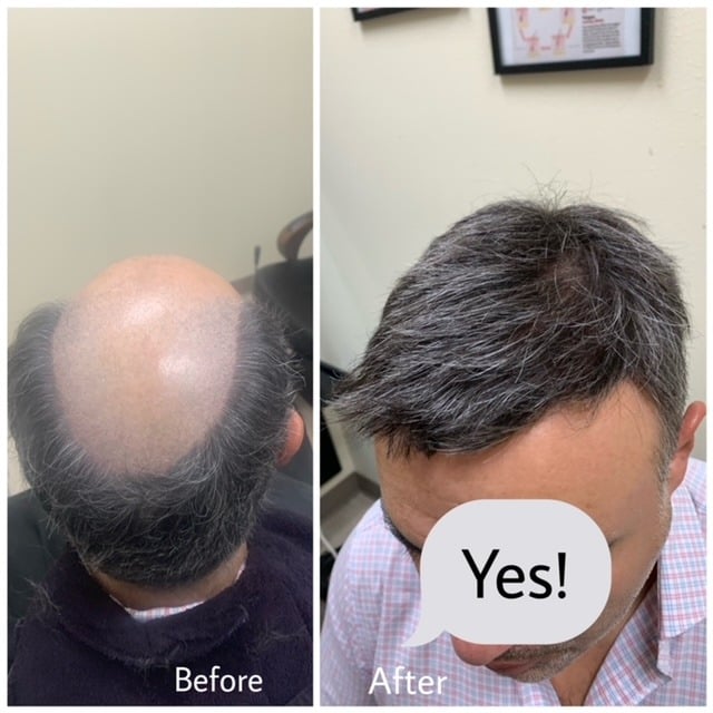 Before hair system treatment showing thinning hair at crown in North York client Before hair system treatment showing thinning hair at crown in North York client