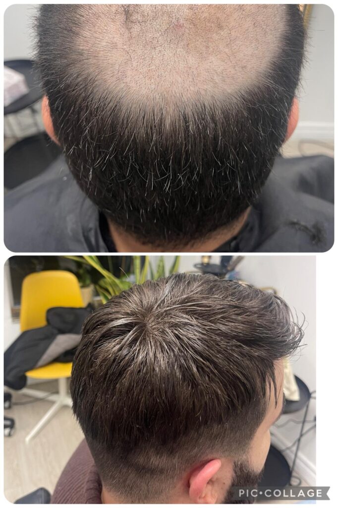 Hair system before and after non surgical